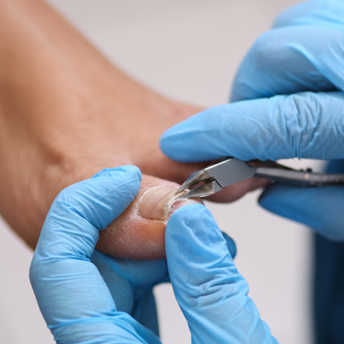 Toenail Care