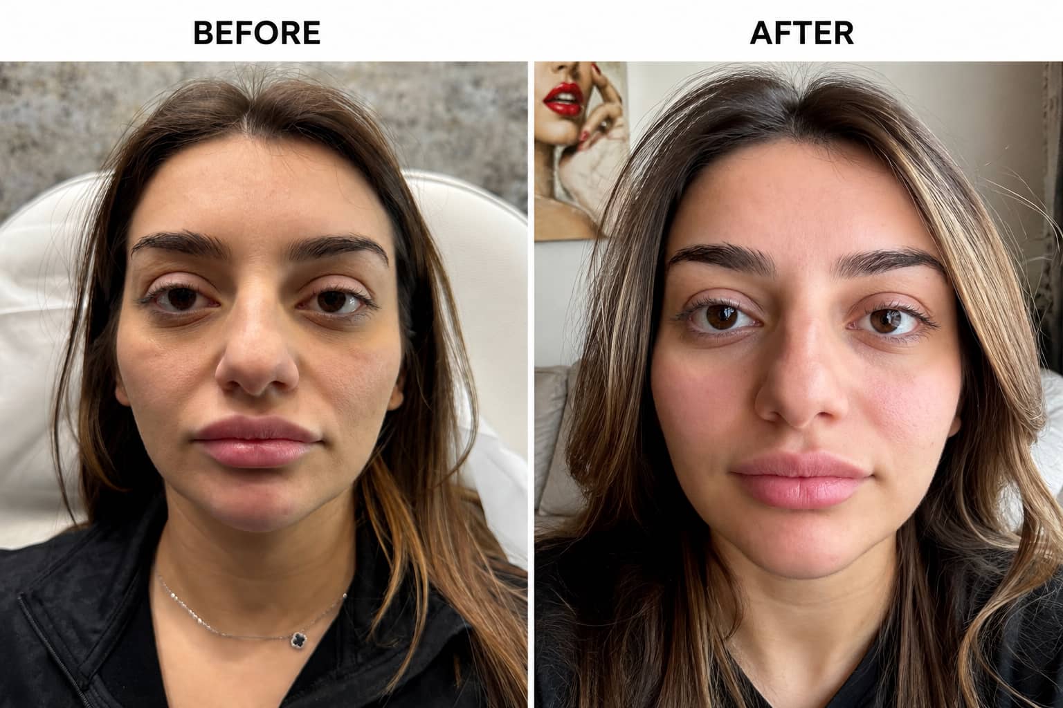 A second Renew Face client's full face before RF microneedling on the left and after on the right, each half labelled in the photograph