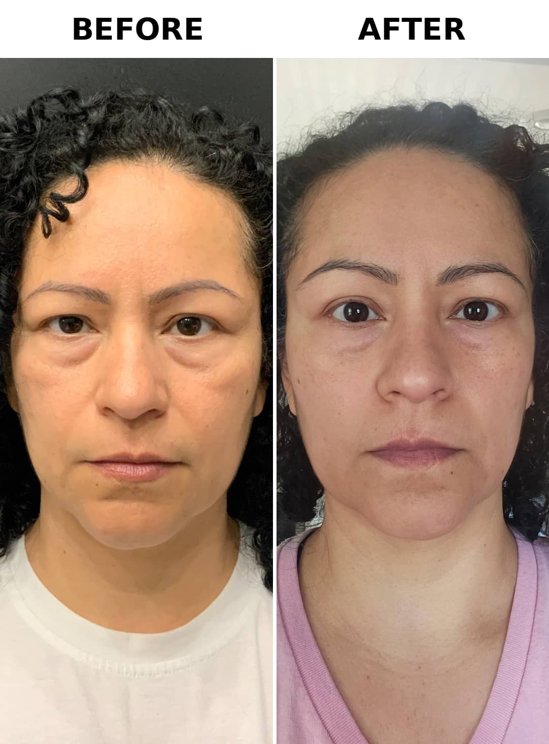 A Renew Face client's full face before RF microneedling on the left and after on the right, each half labelled in the photograph