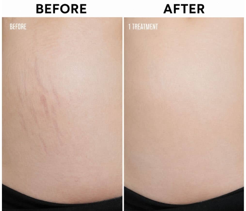 An abdomen before RF microneedling on the left and after a single treatment on the right, the stretch marks visibly faded, each half labelled in the photograph