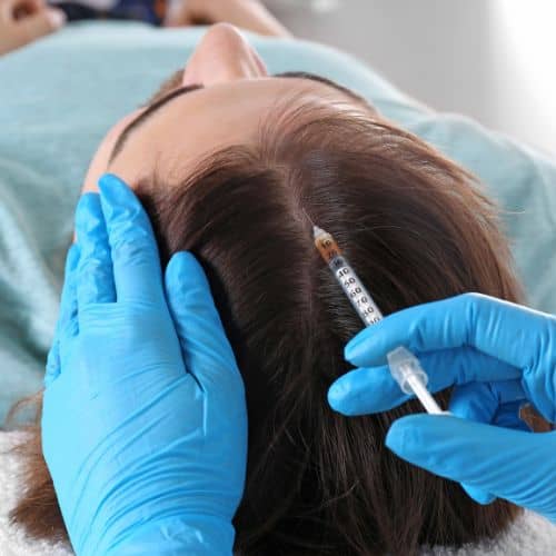 A gloved practitioner parting a client&rsquo;s hair and injecting platelet rich plasma into the scalp