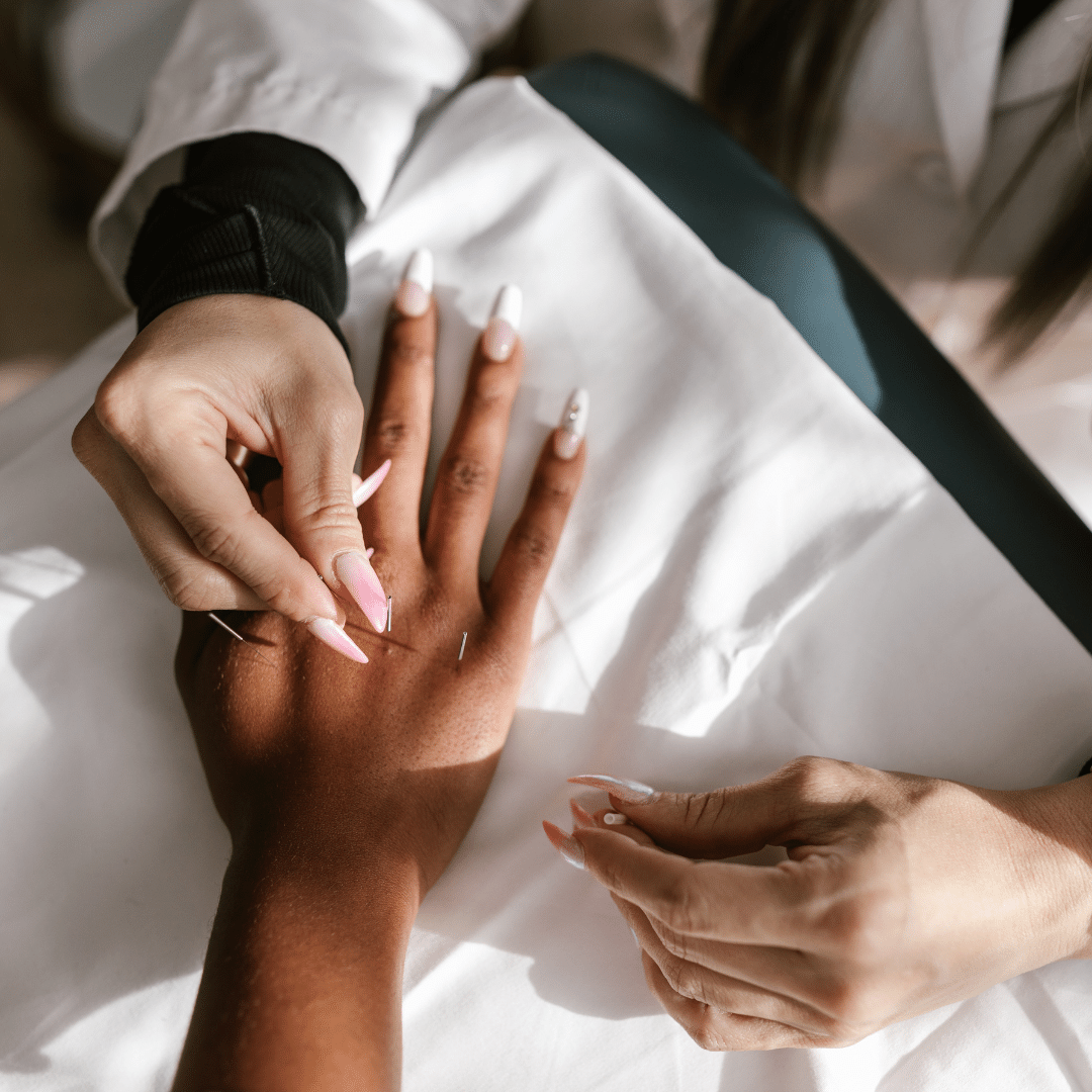 hand acupuncture needling