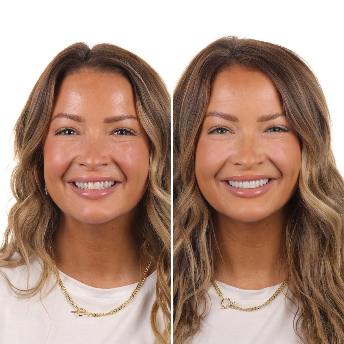 LUCAsmile before and after - Luca Aesthetic