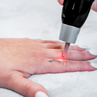 Tattoo Removal in Costa Mesa
