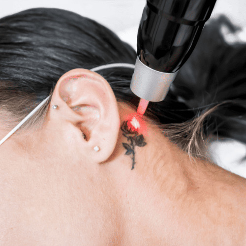  Tattoo Removal