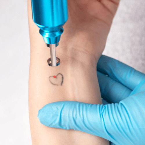 Costa Mesa Tattoo Removal