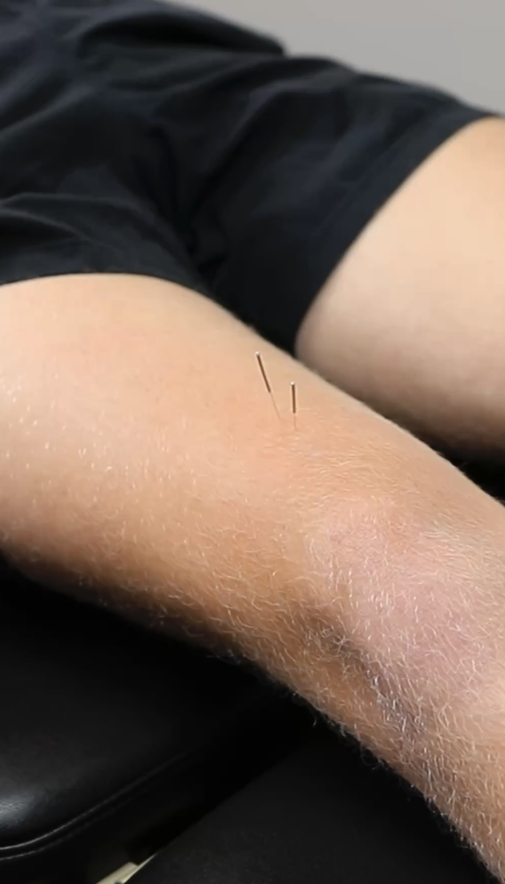Dry needling paired with ultrasound imaging at The Athlete Spot