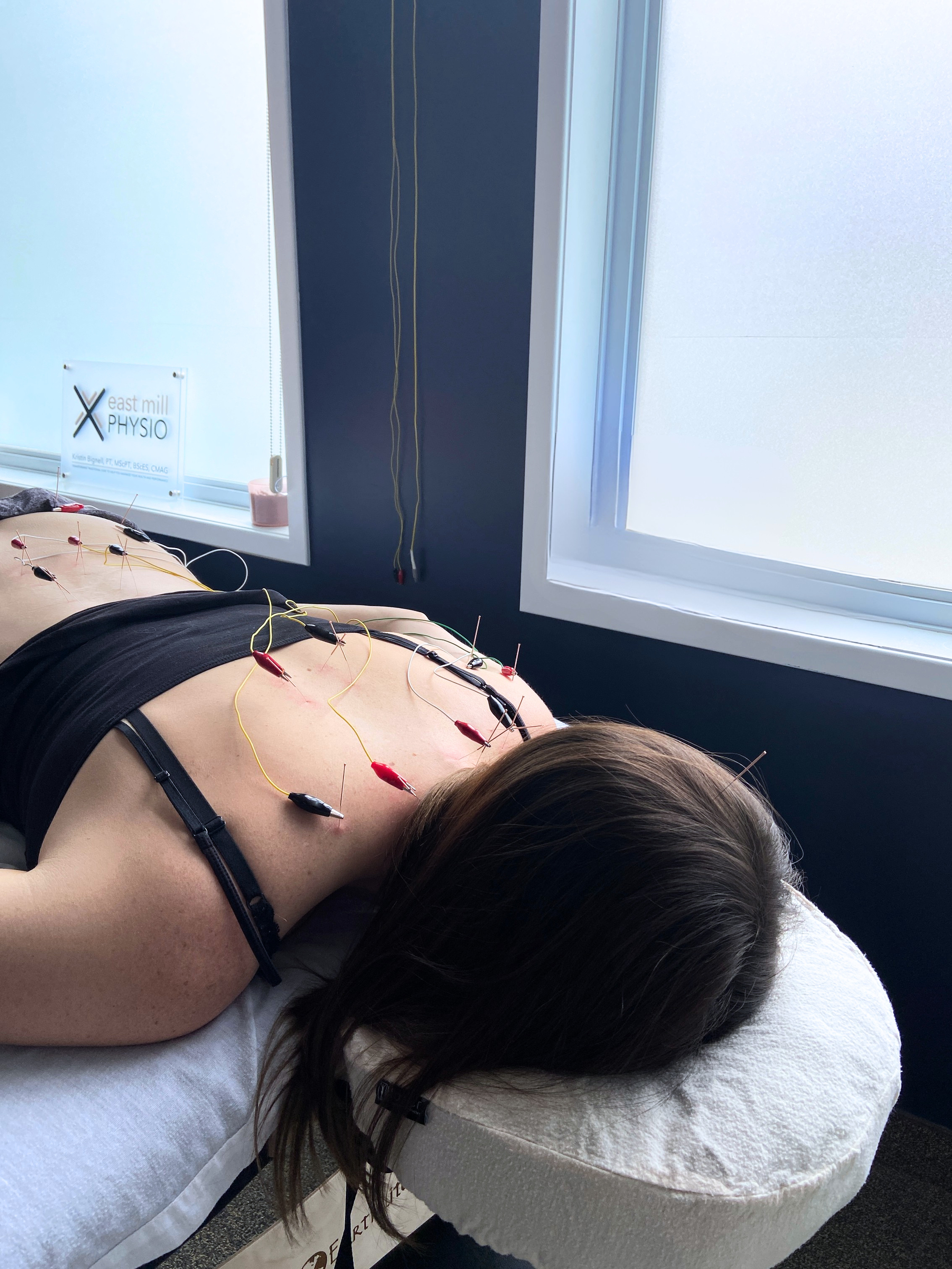 Neurofunctional Acupuncture for Chronic Pain