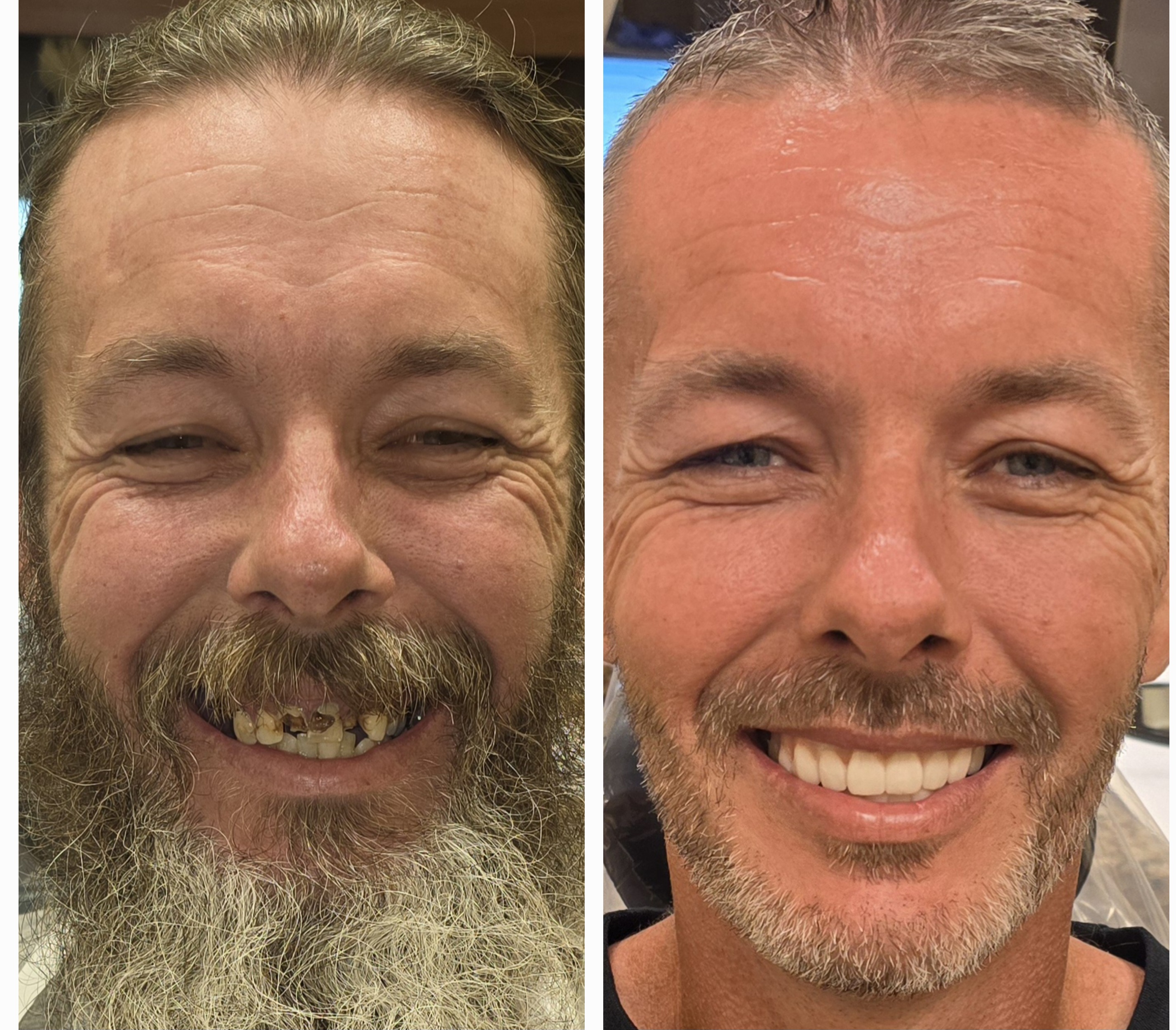 Before and After dental implants result 1
