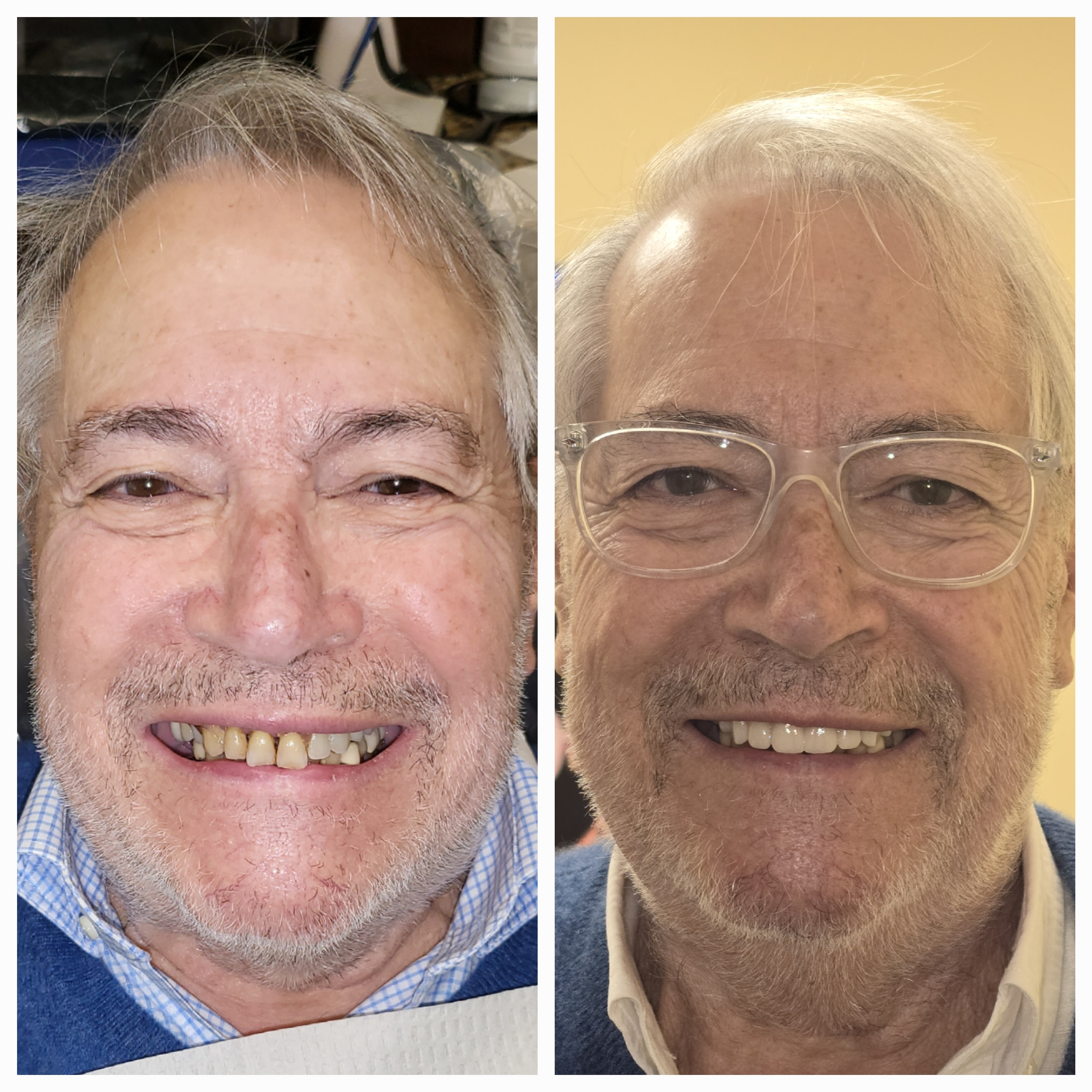 Before and After dental implants result 2