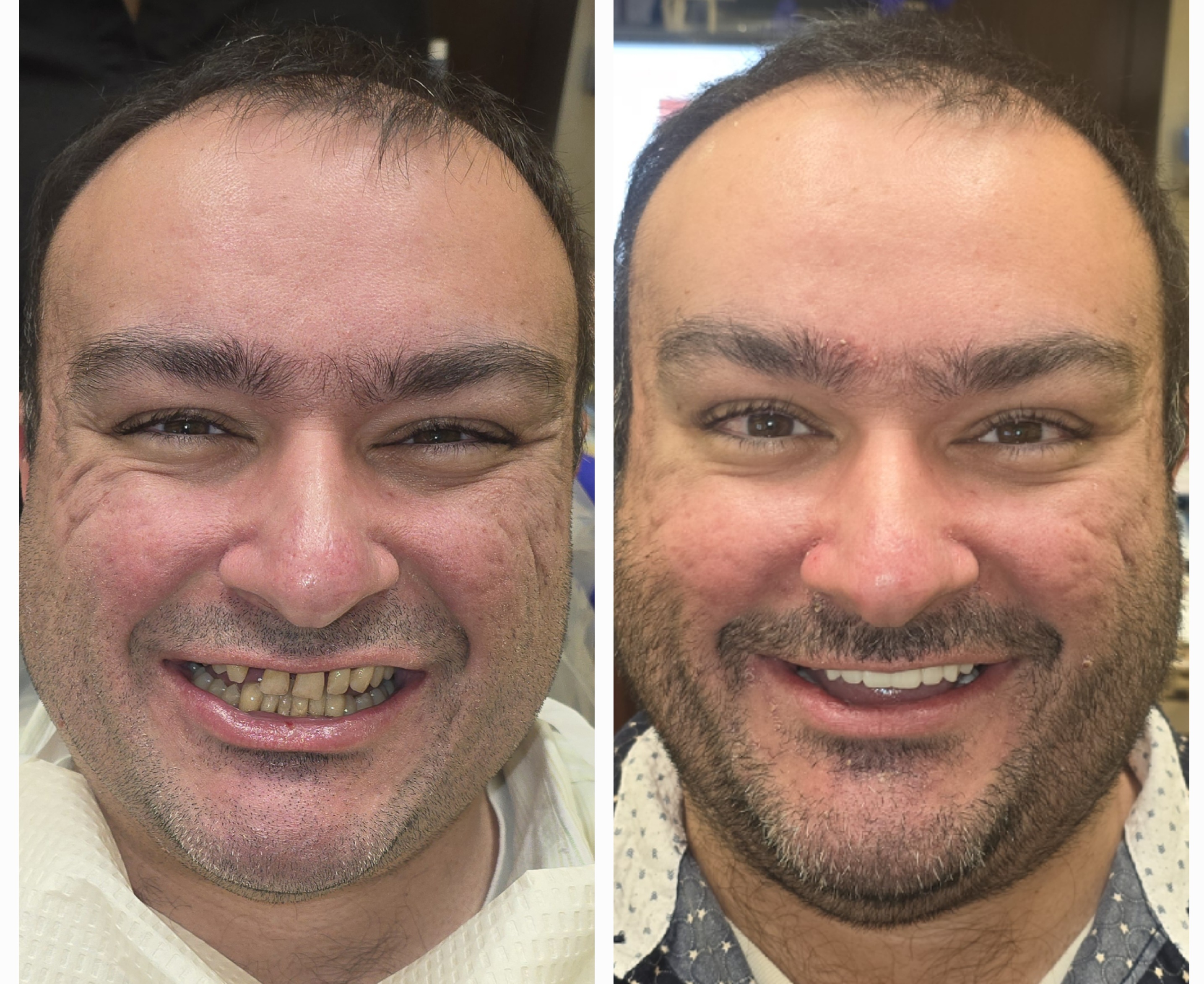 Before and After dental implants result 3