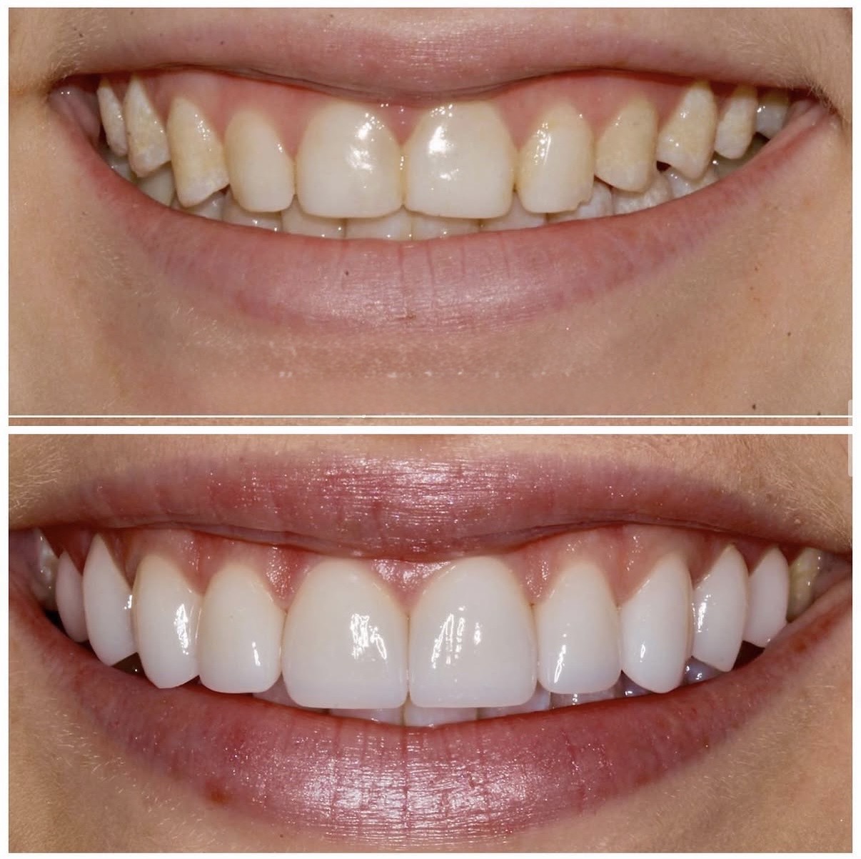 Veneers before and after
