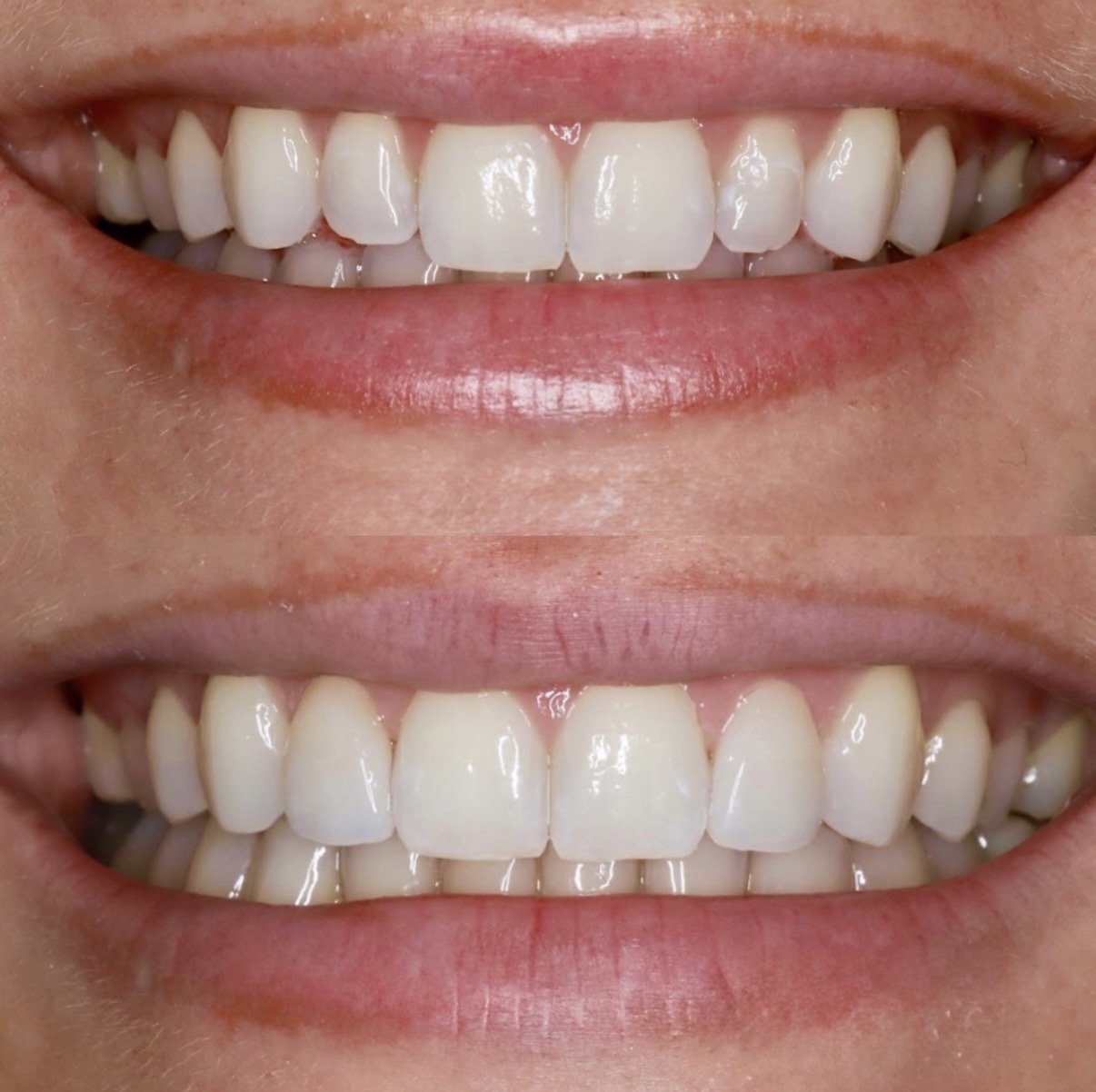 Natural veneer result
