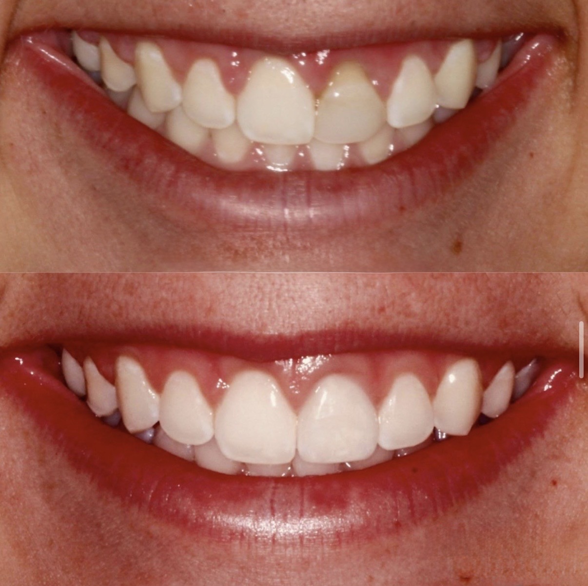 Veneers before and after
