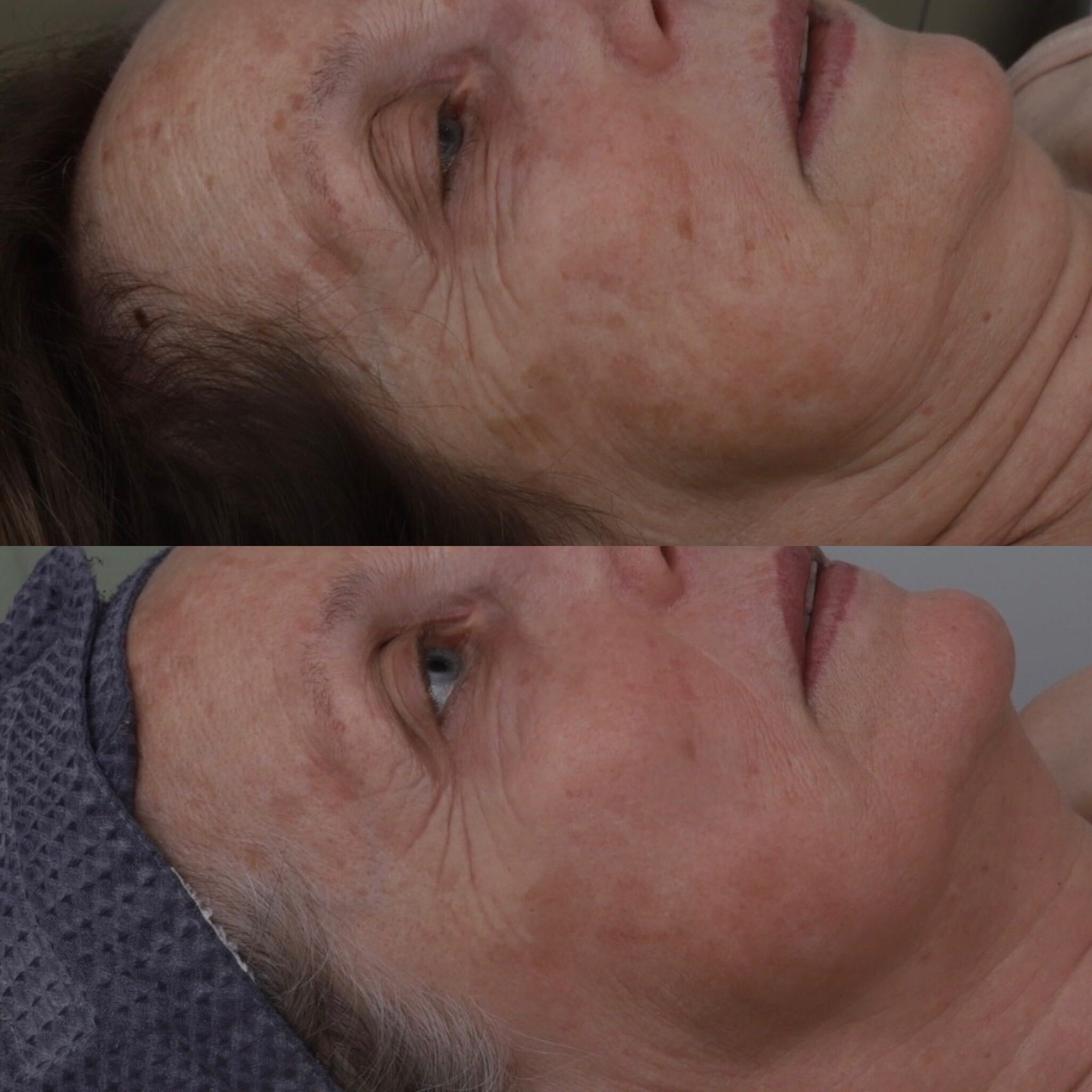 Signature Lower Facelift before and after 2