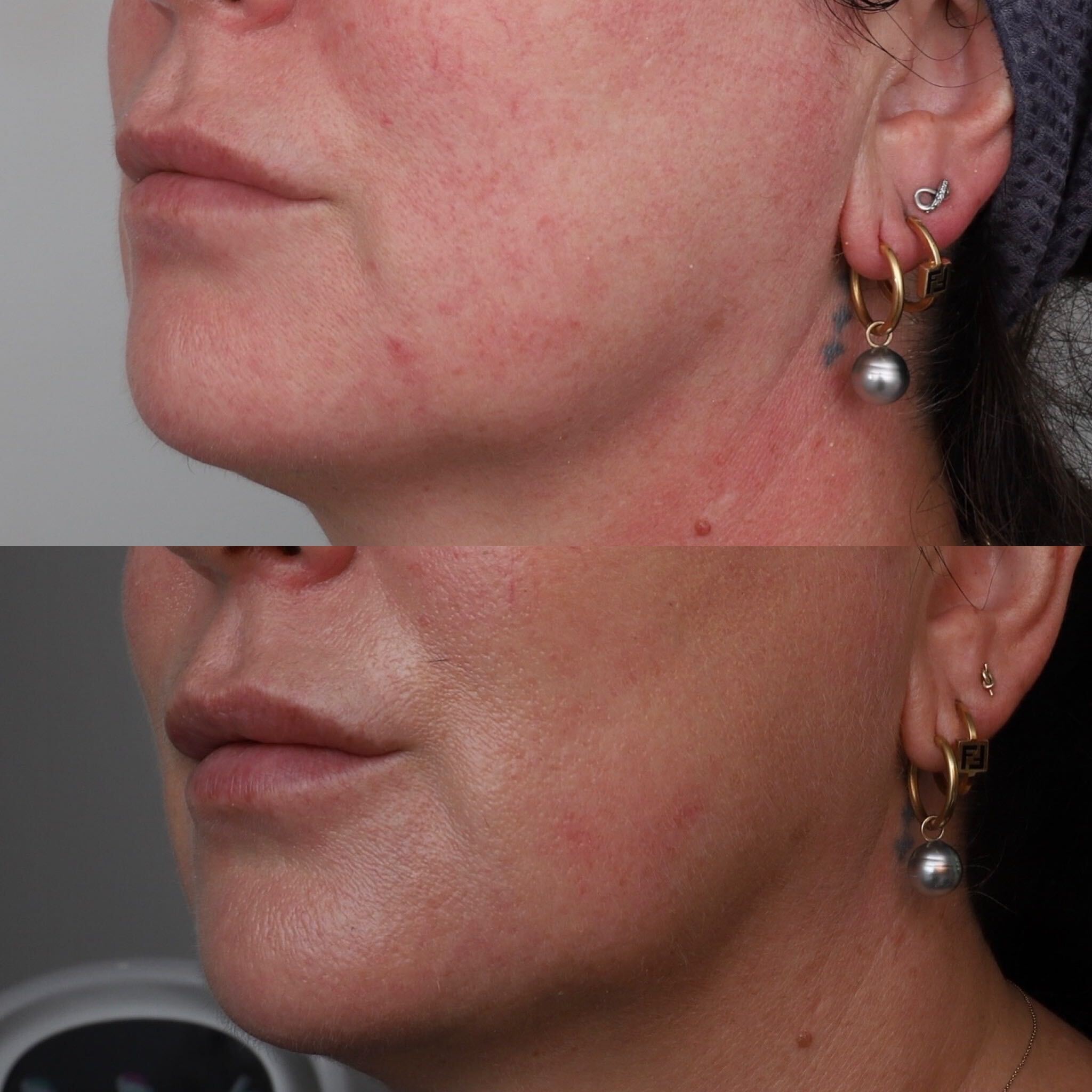 Signature Lower Facelift before and after 3
