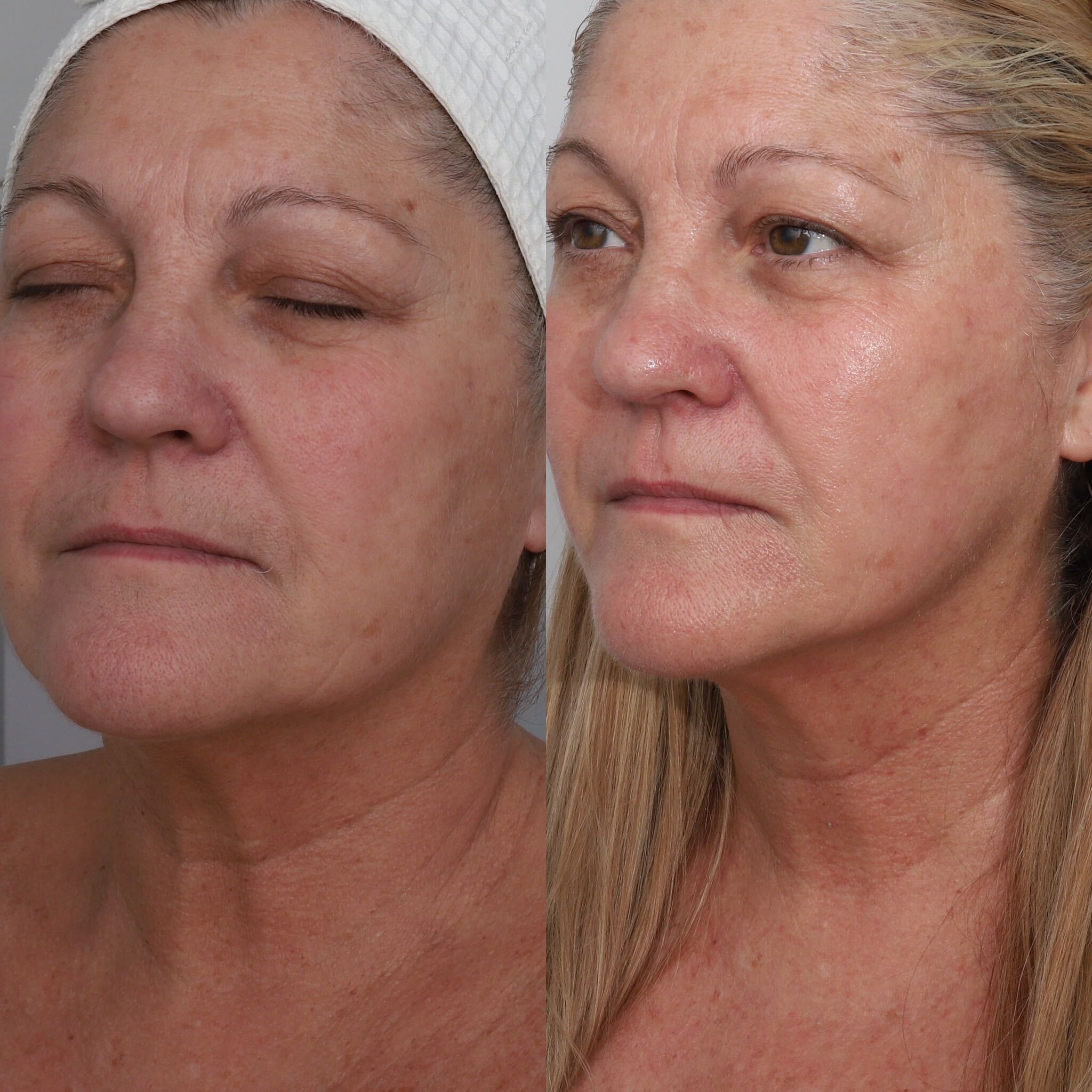 Signature Lower Facelift before and after 4