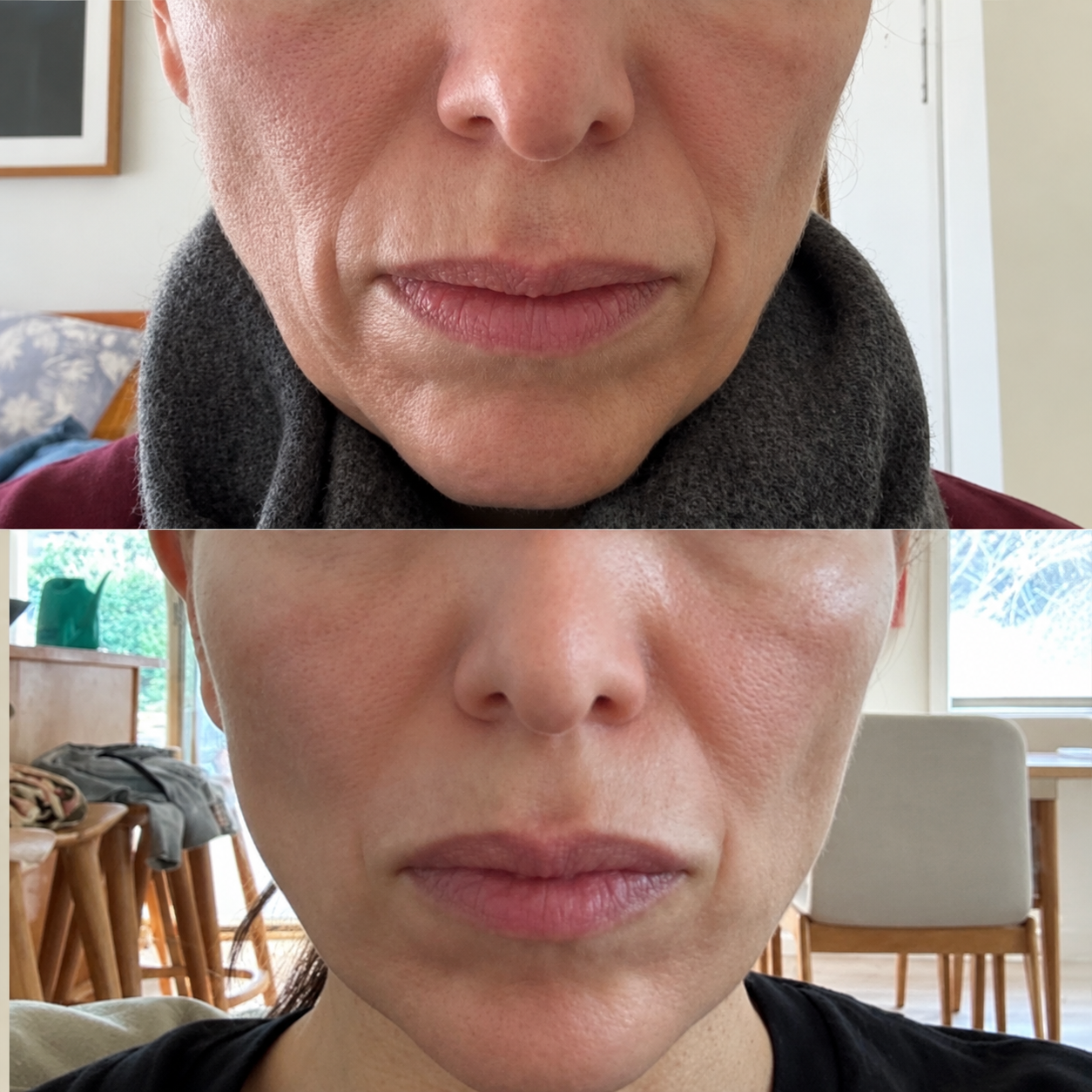 Signature Lower Facelift before and after 1