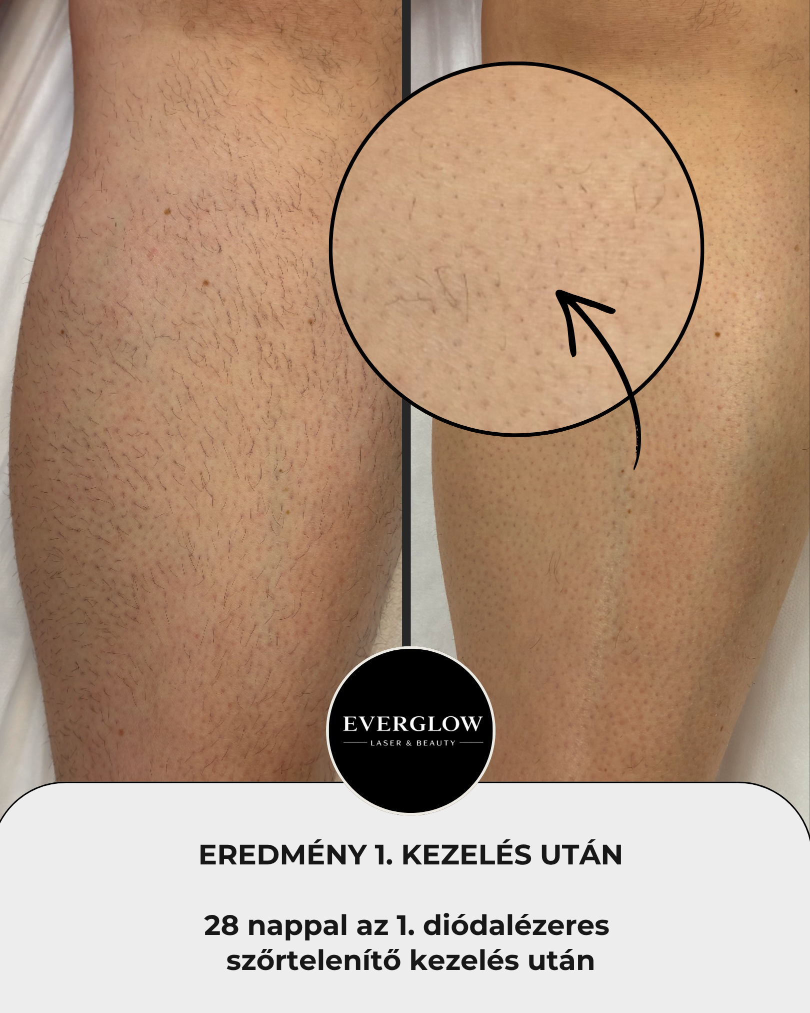 Eredmény az első kezelés után 4