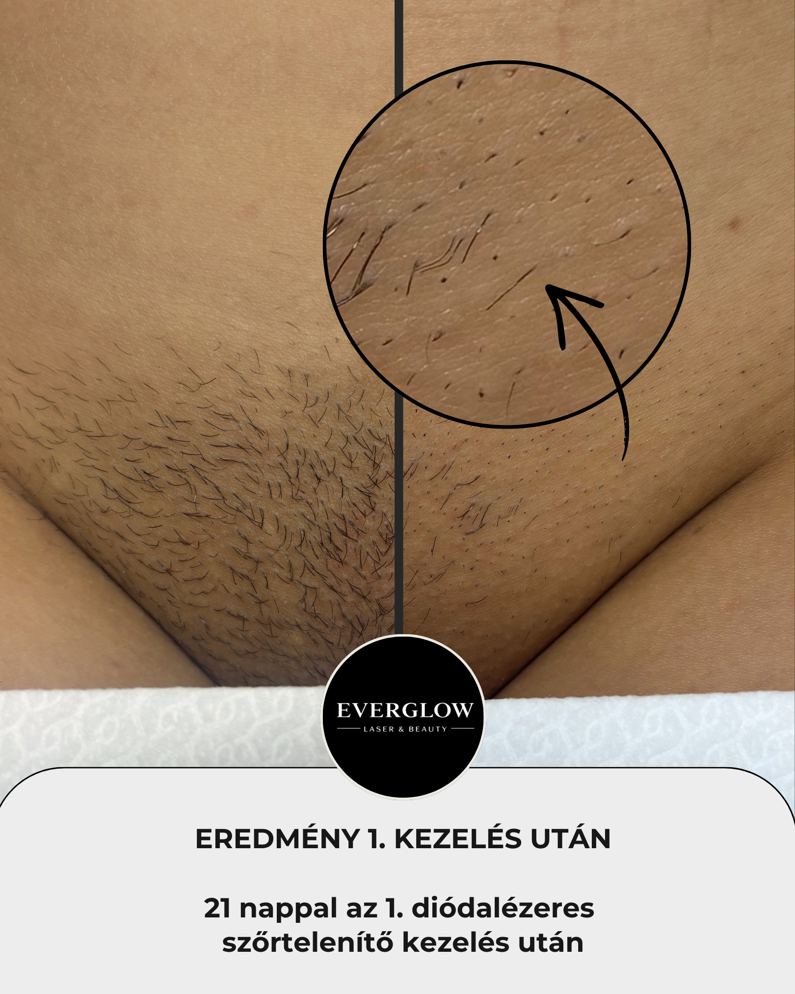 Eredmény az első kezelés után 2