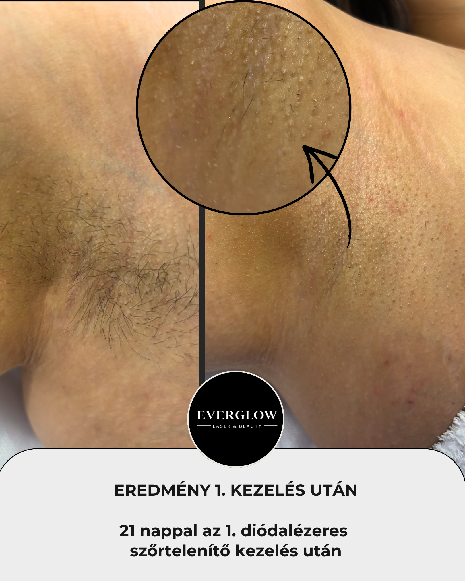Eredmény az első kezelés után 5