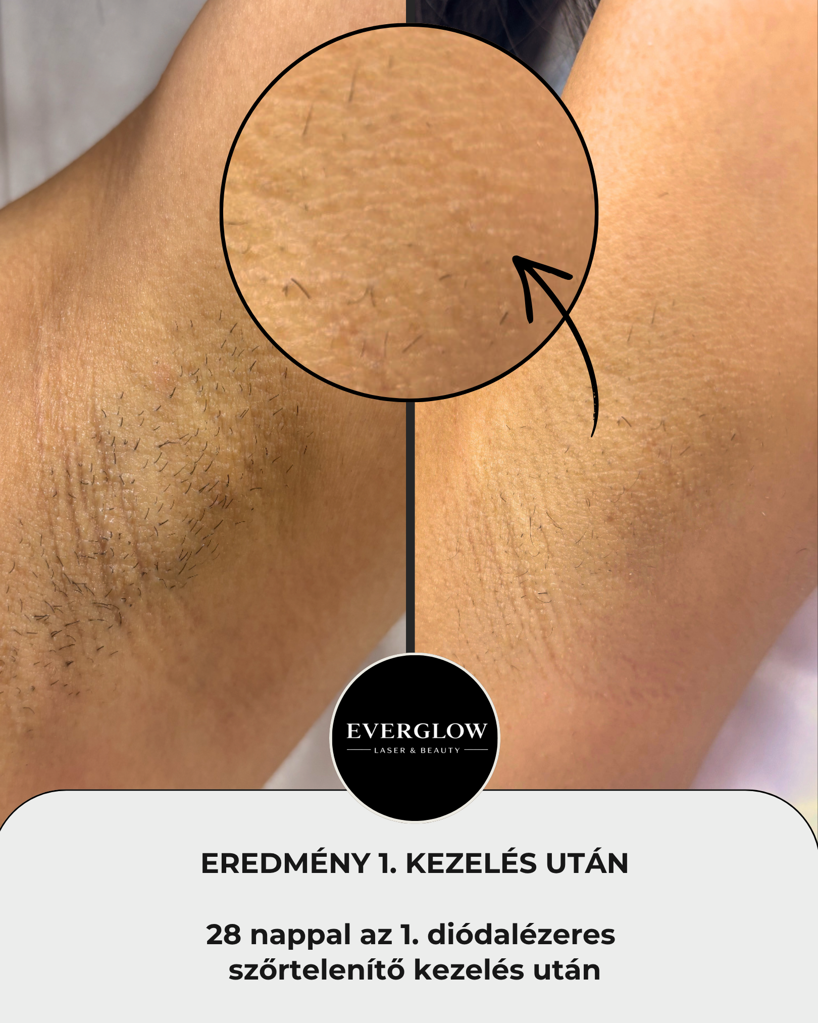 Eredmény az első kezelés után 1