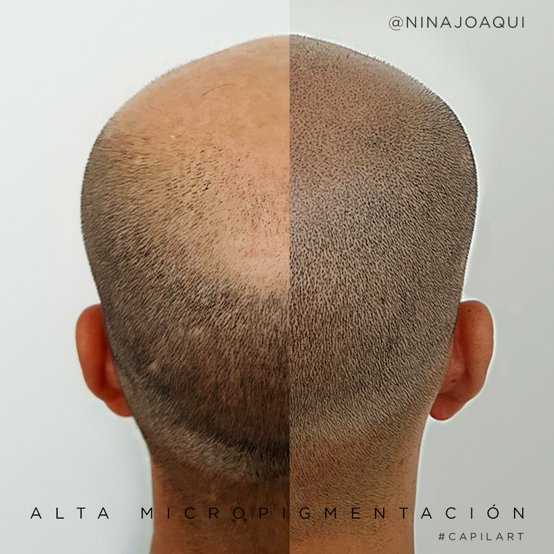 Procedimiento de micropigmentación con técnica Shadow