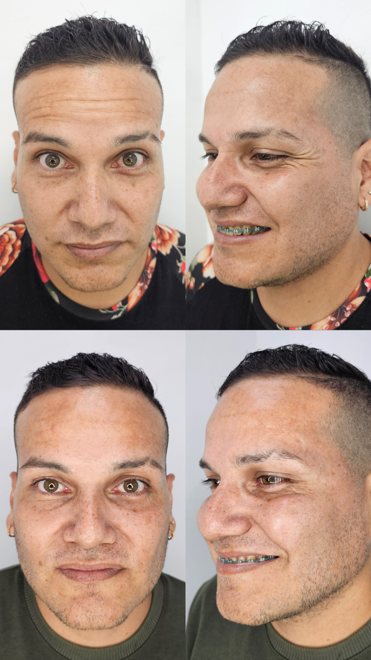 Procedimiento de micropigmentación con técnica Shadow