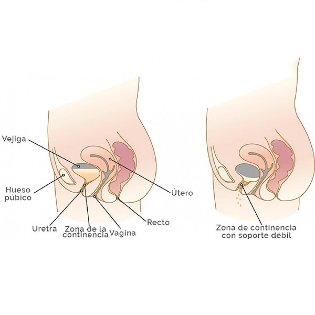 Esquema incontinencia urinaria