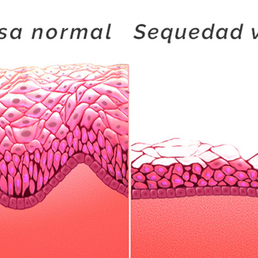 Esquema sequedad vaginal