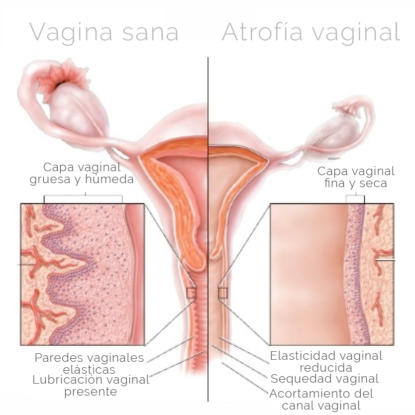 Atrofia vaginal - esquema