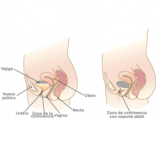 Incontinencia urinaria - esquema