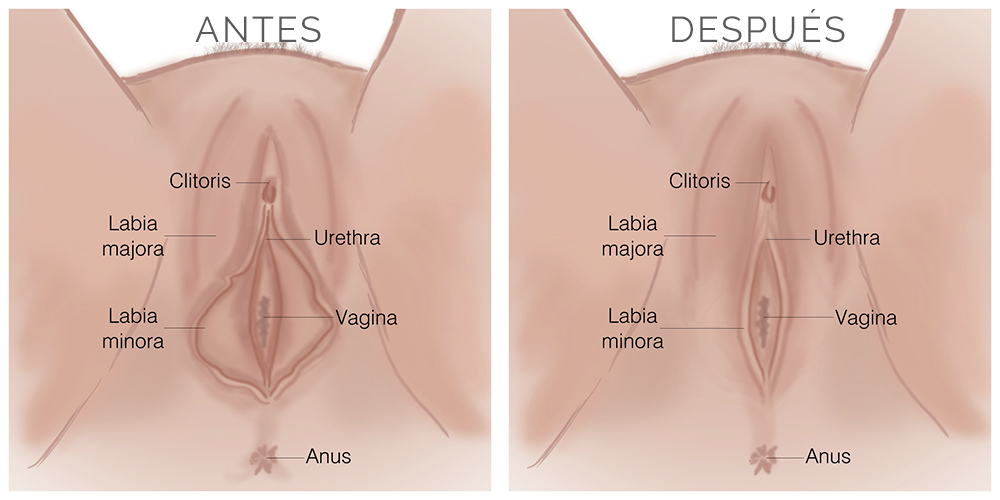 Cirugía íntima láser