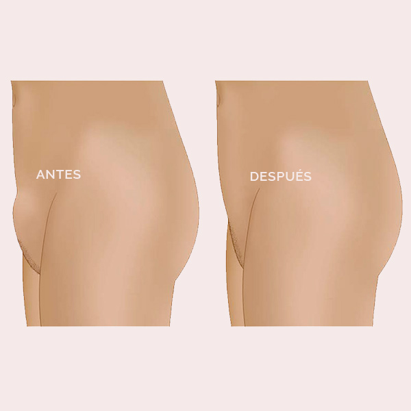 Lipoláser monte de venus