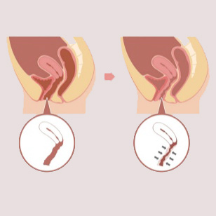 Plastia del introito