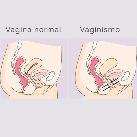 Vaginismo