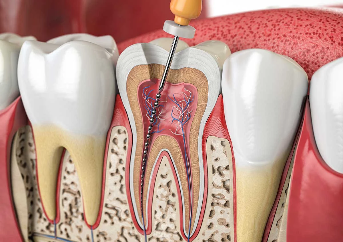 Root Canal