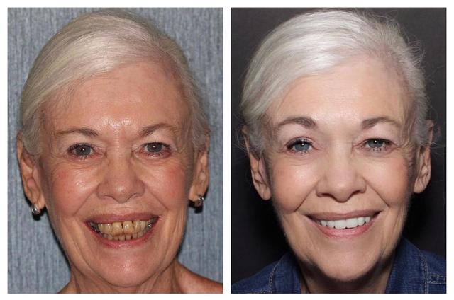 Before and after full-arch implant case