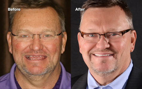 Before and after full-arch implant case