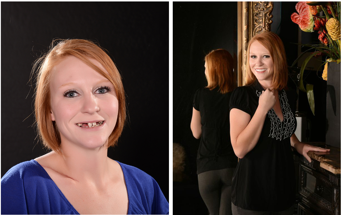 Before and after full-arch implant case