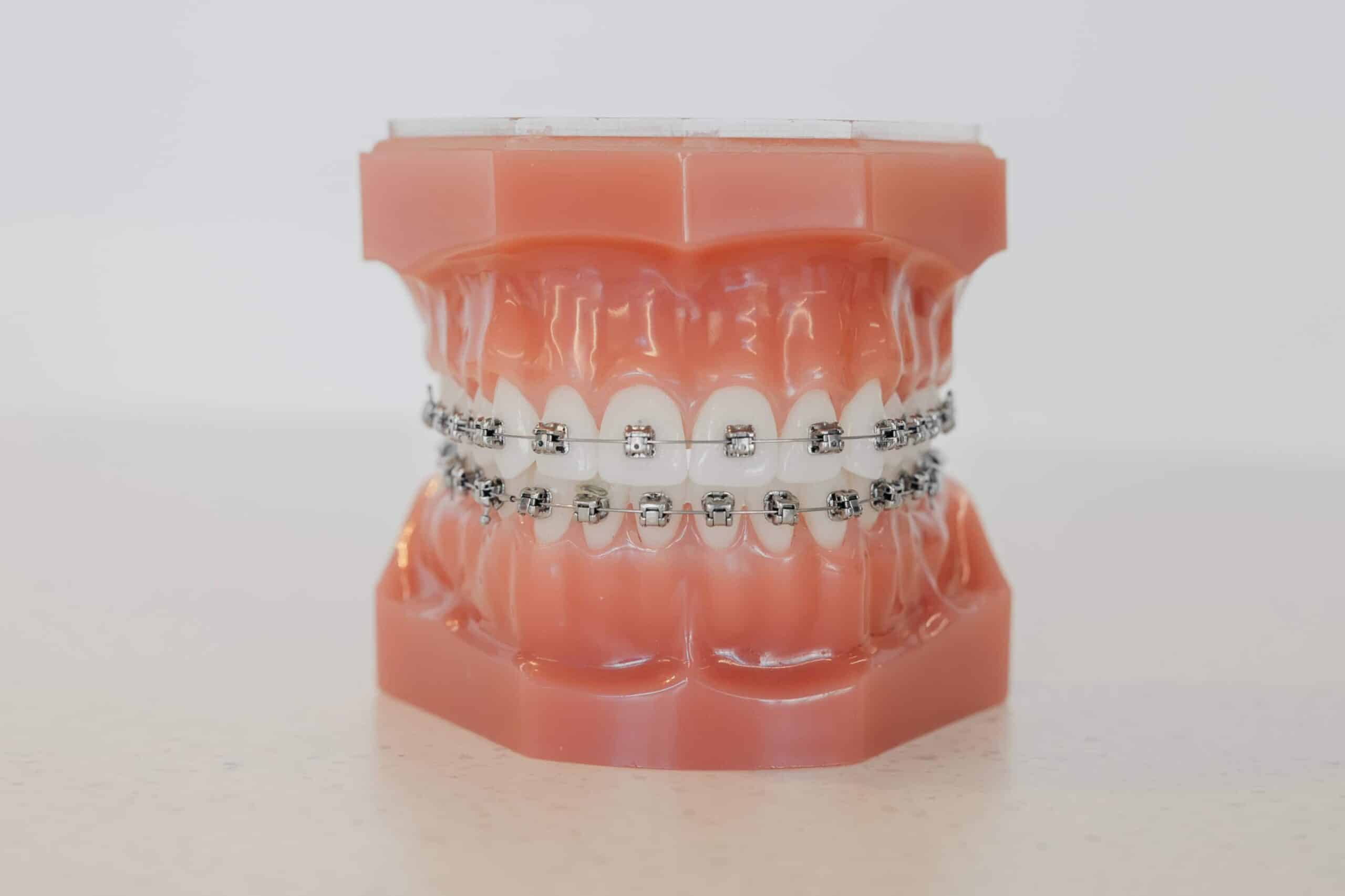 Traditional Braces
