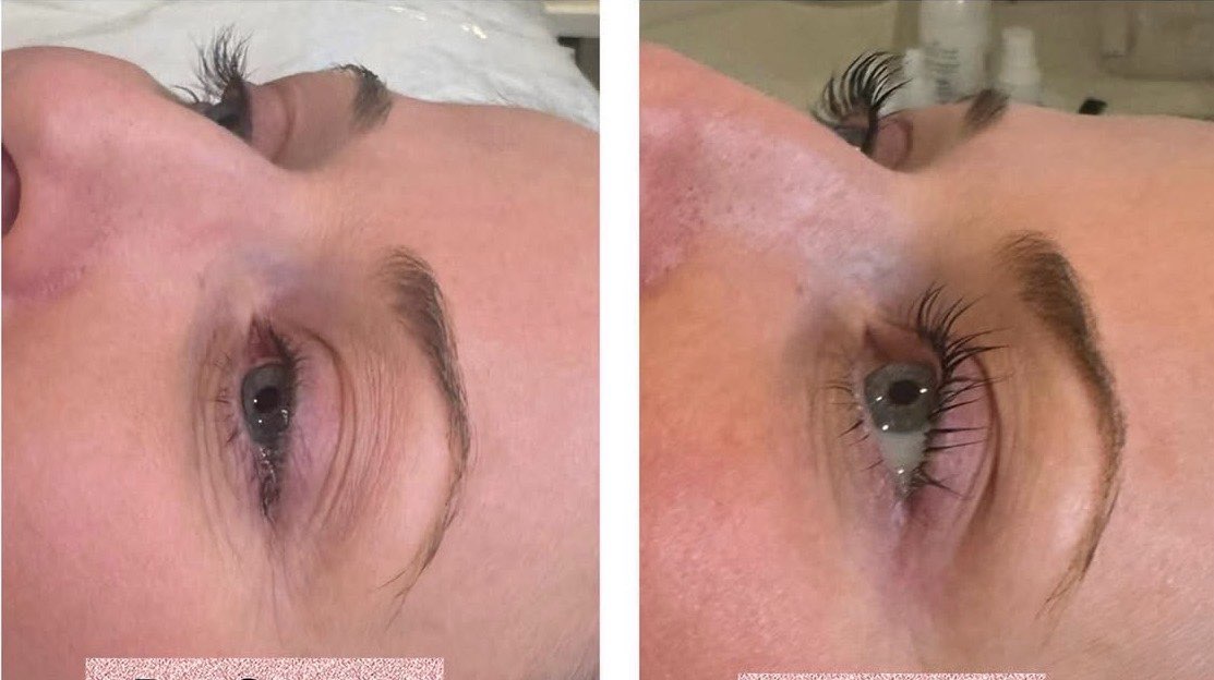 Teeth Whitening Cottonwood Heights