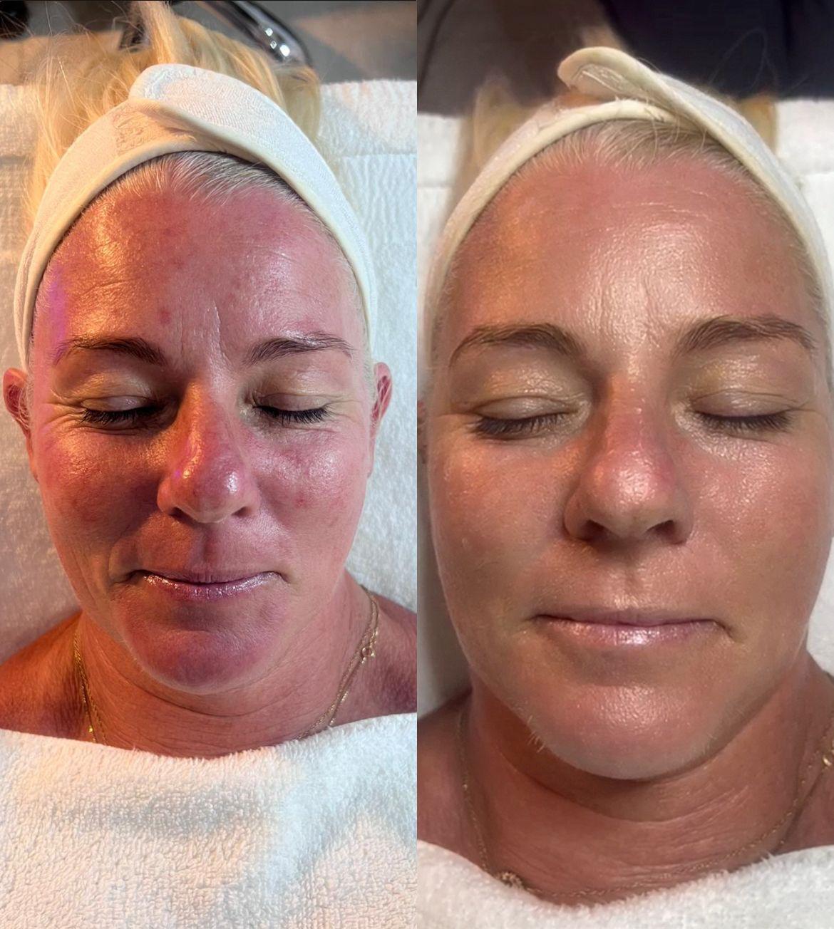 Origani facial before and after