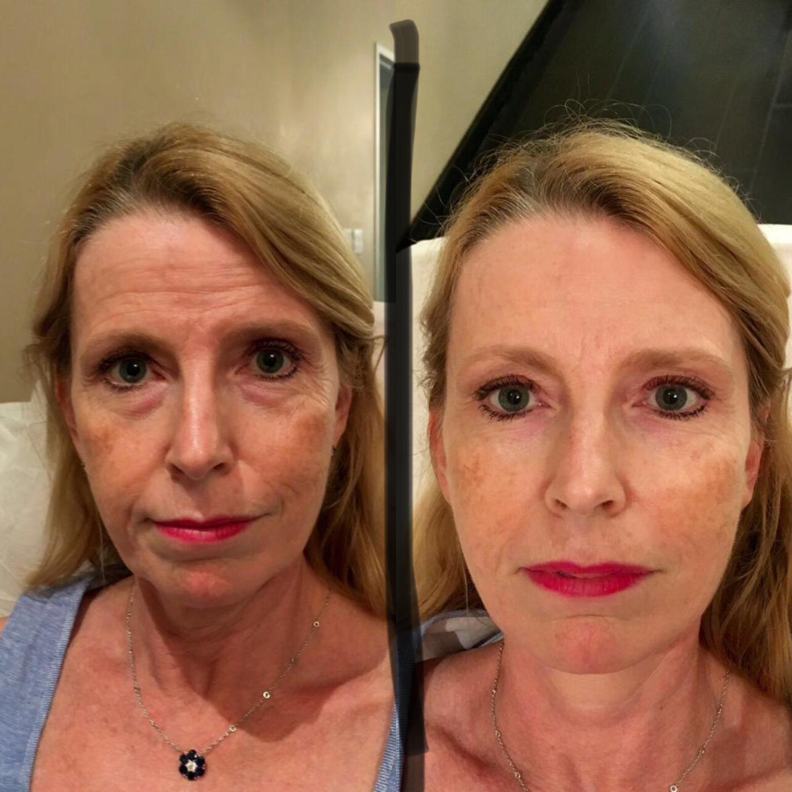 Origani facial before and after