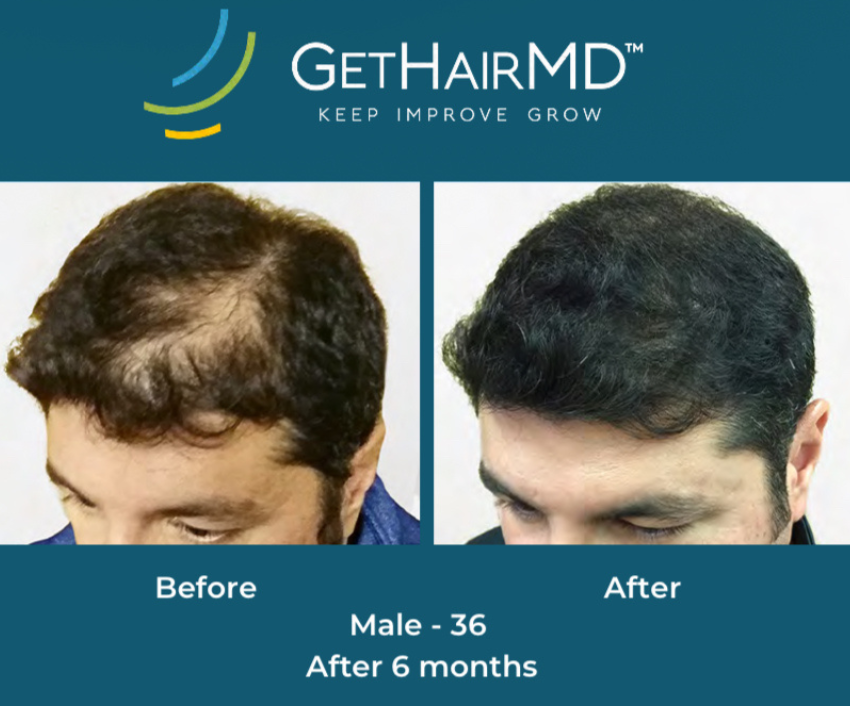 Hair restoration result 3