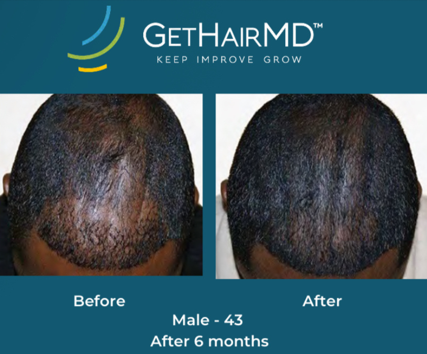 Hair restoration result 4