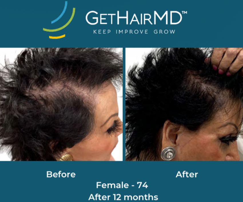 Hair restoration result 5