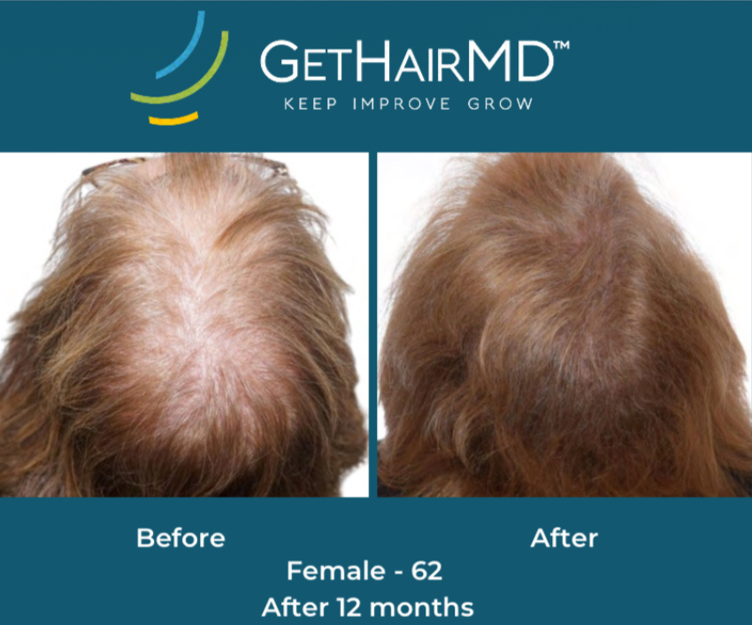 Hair restoration result 7