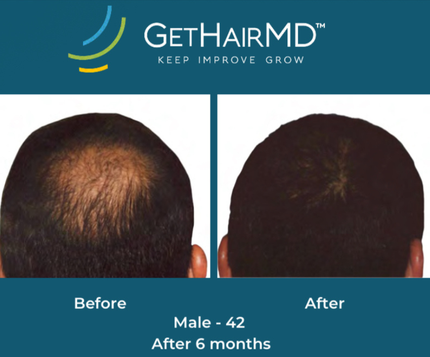 Hair restoration result 8