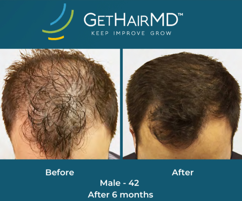 Hair restoration result 6